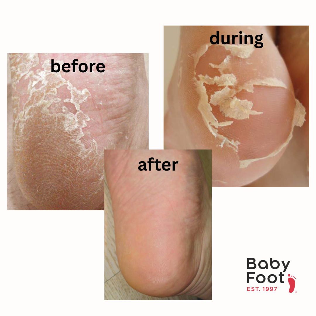 Baby Foot 30 Minute Express Exfoliation Foot Peel